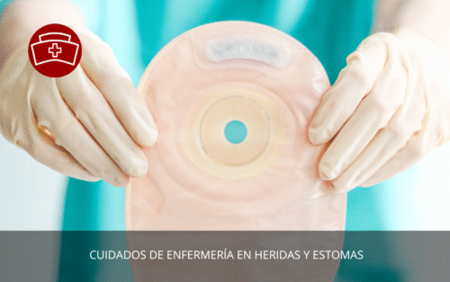 Cuidados de Enfermería en Heridas y Estomas