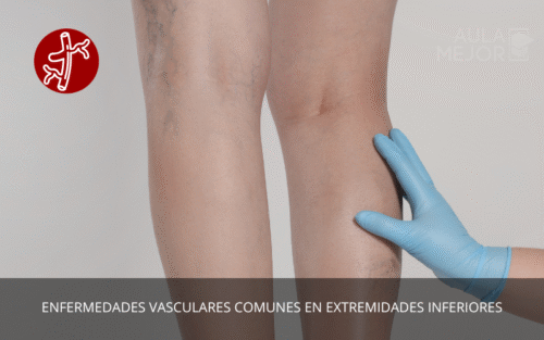 Enfermedades Vasculares Comunes en Extremidades Inferiores