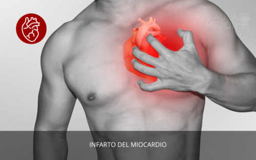 Infarto del Miocardio. Lo que debo saber