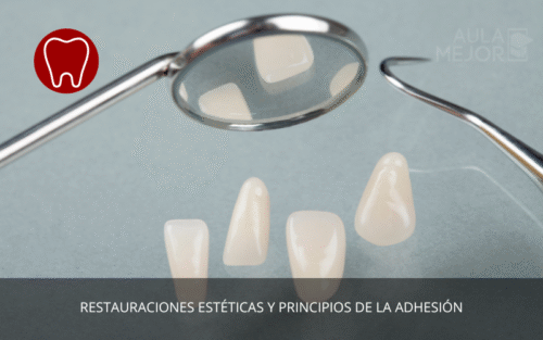 Restauraciones Estéticas y Principios de la Adhesión
