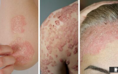 Psoriasis: una mirada integral a sus manifestaciones y manejo terapéutico