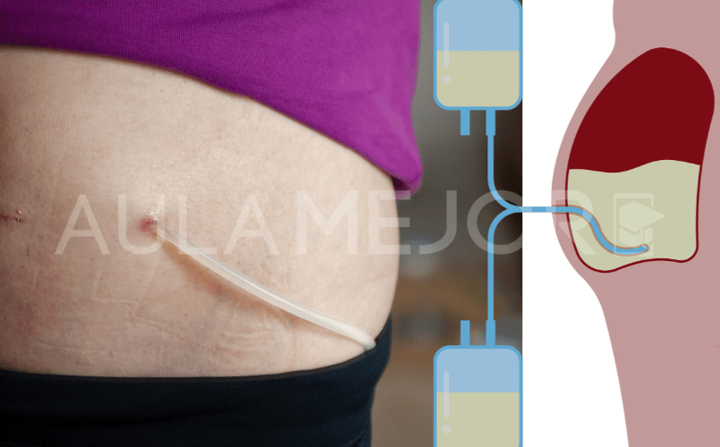 Diálisis peritoneal: tratamiento esencial para la insuficiencia renal crónica