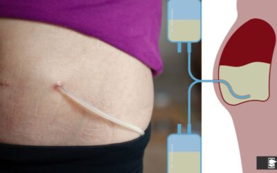 Diálisis peritoneal: tratamiento esencial para la insuficiencia renal crónica